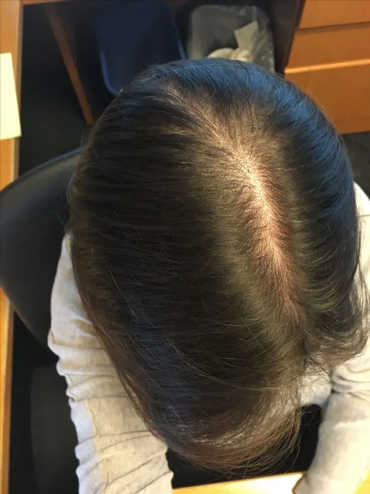 Hair Restoration After