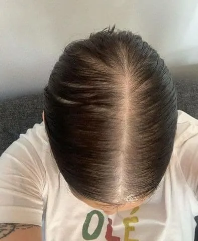 Hair Restoration Before