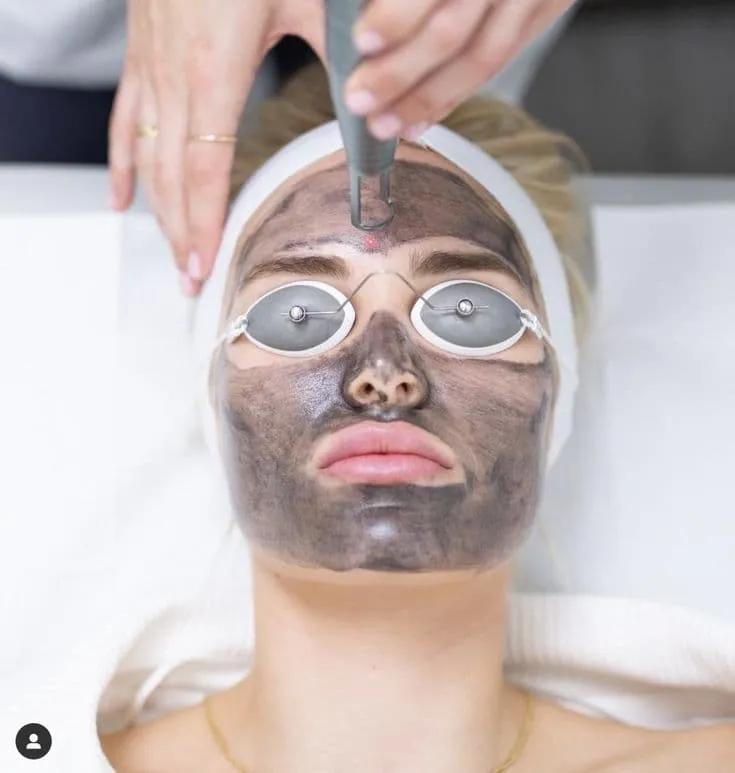 Pigmentation & Melasma Laser