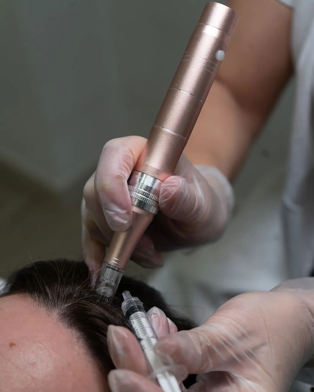 Hair PRP & Concentrated GFC